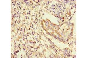 Immunohistochemistry of paraffin-embedded human pancreatic cancer using ABIN7142095 at dilution of 1:100