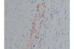 ABIN6256799 and ABIN6267420 at 1/50 staining human colon carcinoma tissue sections by IHC-P. (Phospholipase C gamma 1 anticorps  (pTyr771))