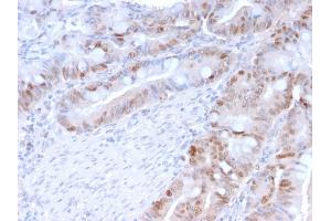 Formalin-fixed, paraffin-embedded human Colon Carcinoma stained with PCNA Mouse Monoclonal Antibody (PC5).
