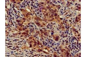 Immunohistochemistry of paraffin-embedded human pancreatic cancer using ABIN7145339 at dilution of 1:100