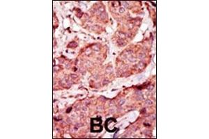 Formalin-fixed and paraffin-embedded human cancer tissue reacted with the primary antibody, which was peroxidase-conjugated to the secondary antibody, followed by AEC staining.