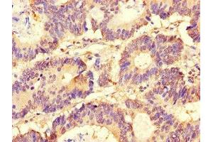 Immunohistochemistry of paraffin-embedded human colon cancer using ABIN7153920 at dilution of 1:100