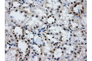 Immunohistochemical staining of paraffin-embedded Carcinoma of liver tissue using anti-IFIT3mouse monoclonal antibody.