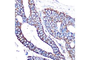 Immunohistochemistry of paraffin-embedded human colon carcinoma using MTCO2 Rabbit mAb (ABIN7266638) at dilution of 1:100 (40x lens). (COX2 anticorps)
