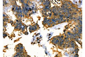 ABIN6263792 and ABIN6277681 at 1/100 staining Human ovarian cancer by IHC-P. (OCA2 anticorps  (N-Term))