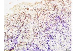 Formalin-fixed and paraffin embedded Human endometrium carcinoma labeled Anti-Livin Polyclonal Antibody, Unconjugated  at 1:200, followed by conjugation to the secondary antibody and DAB staining (BIRC7 anticorps  (AA 101-200))