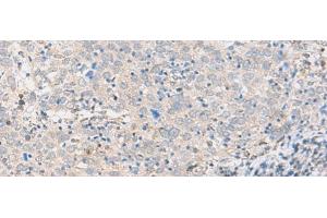 Immunohistochemistry of paraffin-embedded Human cervical cancer tissue using ABHD17B Polyclonal Antibody at dilution of 1:35(x200) (ABHD17B anticorps)