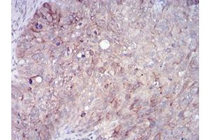 Immunohistochemical analysis of paraffin-embedded cervical cancer tissues using RAB11FIP1 mouse mAb with DAB staining. (RAB11FIP1 anticorps  (AA 130-271))