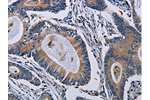The image on the left is immunohistochemistry of paraffin-embedded Human colon cancer tissue using ABIN7191804(PCDHAC1 Antibody) at dilution 1/50, on the right is treated with synthetic peptide. (PCDHAC1 anticorps)