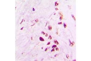 Immunohistochemical analysis of p53 staining in human lung cancer formalin fixed paraffin embedded tissue section. (p53 anticorps  (C-Term))