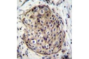 Immunohistochemistry analysis in formalin fixed and paraffin embedded human breast carcinoma reacted with GMP reductase 1 / GMPR1 Antibody (C-term) followed by peroxidase conjugation of the secondary antibody and DAB staining. (GMPR anticorps  (C-Term))