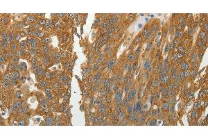 Immunohistochemistry of paraffin-embedded Human ovarian cancer using RPLP0 Polyclonal Antibody at dilution of 1:40