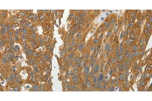 Immunohistochemistry of paraffin-embedded Human ovarian cancer using RPLP0 Polyclonal Antibody at dilution of 1:40 (RPLP0 anticorps)