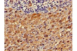 Immunohistochemistry of paraffin-embedded human liver cancer using ABIN7144595 at dilution of 1:100 (ASL anticorps  (AA 2-300))
