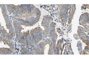 ABIN6274649 at 1/100 staining Human cervical cancer tissue by IHC-P. (CYP2E1 anticorps  (Internal Region))