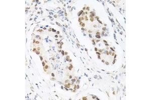 Immunohistochemistry of paraffin-embedded human gastric cancer using KPNA4 Antibody.