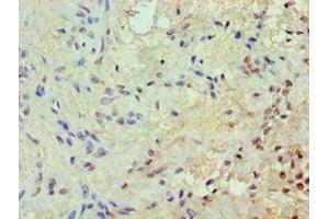 Immunohistochemistry of paraffin-embedded human breast cancer using ABIN7172569 at dilution of 1:100 (JunB anticorps  (AA 1-240))