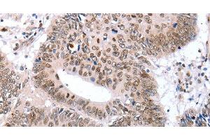 Immunohistochemistry of paraffin-embedded Human colon cancer tissue using TBX2 Polyclonal Antibody at dilution 1:32 (TBX2 anticorps)