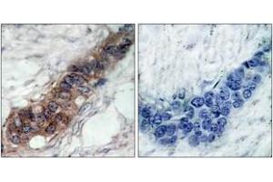 Immunohistochemistry analysis of paraffin-embedded human breast carcinoma tissue, using JAK2 (Ab-221) Antibody. (JAK2 anticorps  (AA 191-240))