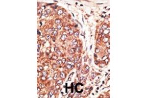Formalin-fixed and paraffin-embedded human cancer tissue reacted with the primary antibody, which was peroxidase-conjugated to the secondary antibody, followed by AEC staining.