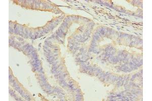 Immunohistochemistry of paraffin-embedded human endometrial cancer using ABIN7161717 at dilution of 1:100 (NRARP anticorps  (AA 1-114))
