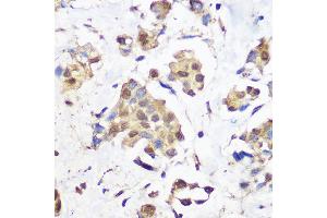 Immunohistochemistry of paraffin-embedded human breast cancer using KDM1 / LSD1 Rabbit mAb (ABIN7268324) at dilution of 1:100 (40x lens).