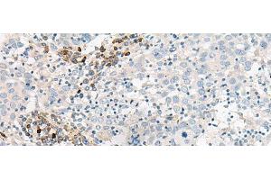 Immunohistochemistry of paraffin-embedded Human cervical cancer tissue using GUCA1B Polyclonal Antibody at dilution of 1:45(x200) (GUCA1B anticorps)