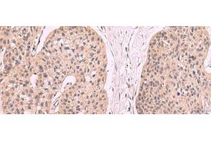 Immunohistochemistry of paraffin-embedded Human esophagus cancer tissue using KLRB1 Polyclonal Antibody at dilution of 1:55(x200) (CD161 anticorps)