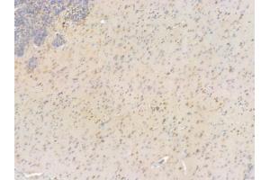 ABIN6255551 and ABIN6267431 at 1/100 staining human glioblastoma by IHC-P.