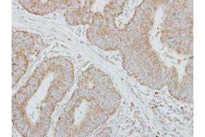IHC-P Image Immunohistochemical analysis of paraffin-embedded human colon carcinoma, using Factor IX, antibody at 1:250 dilution.