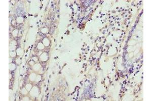 Immunohistochemistry of paraffin-embedded human colon cancer using ABIN7168900 at dilution of 1:100