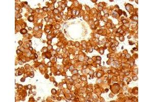IHC testing of human melanoma stained with CD63 antibody (MX49. (CD63 anticorps)