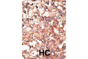 Formalin-fixed and paraffin-embedded human hepatocellular carcinoma tissue reacted with BMP5 polyclonal antibody  , which was peroxidase-conjugated to the secondary antibody, followed by AEC staining. (BMP5 anticorps  (N-Term))