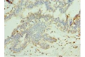 Immunohistochemistry of paraffin-embedded human breast cancer using ABIN7159998 at dilution of 1:100 (MAPK15 anticorps  (AA 1-95))