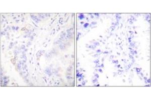 Immunohistochemistry analysis of paraffin-embedded human lung carcinoma tissue, using CrkII (Ab-221) Antibody. (Crk anticorps  (AA 187-236))