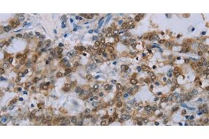Immunohistochemistry of paraffin-embedded Human liver cancer tissue using MED12 Polyclonal Antibody at dilution 1:40 (MED12 anticorps)