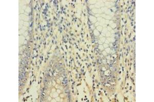 Immunohistochemistry of paraffin-embedded human colon cancer using ABIN7166354 at dilution of 1:100 (YPEL1 anticorps  (AA 1-119))