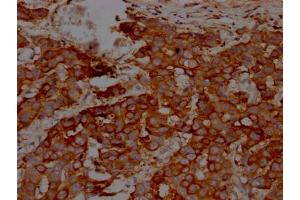 IHC image of ABIN7127566 diluted at 1:100 and staining in paraffin-embedded human breast cancer performed on a Leica BondTM system.