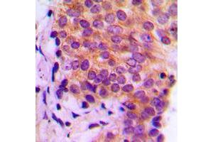 Immunohistochemical analysis of Galectin 9 staining in human breast cancer formalin fixed paraffin embedded tissue section.