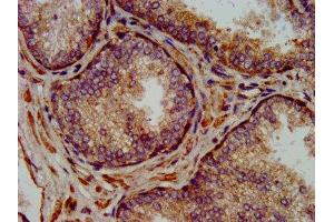 IHC image of ABIN7160835 diluted at 1:300 and staining in paraffin-embedded human prostate cancer performed on a Leica BondTM system.