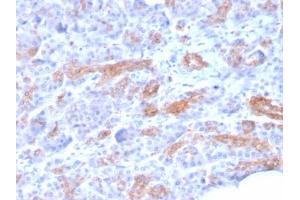 Formalin-fixed, paraffin-embedded human Pancreatic Carcinoma stained with MRP3 Mouse Monoclonal Antibody (ABCC3/2971).