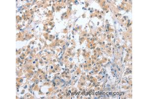 Immunohistochemistry of Human prostate cancer using CD200R1 Polyclonal Antibody at dilution of 1:70 (HCRTR2 anticorps)