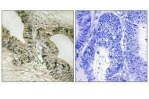 Immunohistochemistry analysis of paraffin-embedded human colon carcinoma tissue using GRB2 (Ab-159) antibody. (GAB2 anticorps  (Ser159))