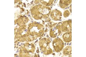 Immunohistochemistry of paraffin-embedded Human gastric using Tp53 antibody at dilution of 1:100 (x400 lens).