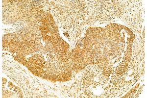 ABIN6262106 and ABIN6273119 at 1/100 staining Human lung cancer by IHC-P. (GSDMD anticorps)