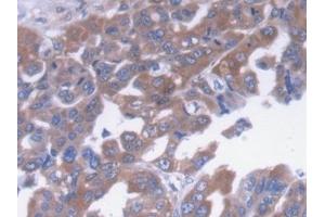 Detection of a2M in Human Liver cancer Tissue using Monoclonal Antibody to Alpha-2-Macroglobulin (a2M)