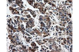Immunohistochemical staining of paraffin-embedded Carcinoma of liver tissue using anti-FAHD2Amouse monoclonal antibody. (FAHD2A anticorps)