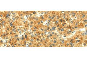 Immunohistochemistry of paraffin-embedded Human liver cancer using THAP3 Polyclonal Antibody at dilution of 1/30 (THAP3 anticorps)