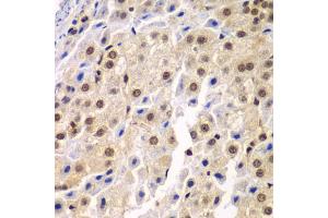 Immunohistochemistry of paraffin-embedded human liver cancer using SF3B2 antibody (ABIN5973482) at dilution of 1/100 (40x lens). (SF3B2 anticorps)