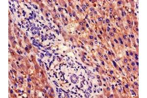 Immunohistochemistry of paraffin-embedded human liver cancer using ABIN7164982 at dilution of 1:100